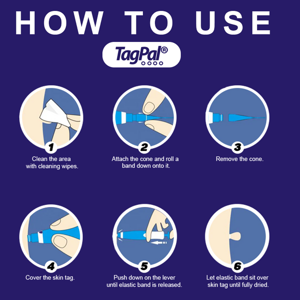 TagPal Easy Skin Tag Remover